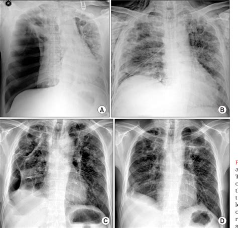 Figure 1 from A Case of Pulmonary Mycobacterium kansasii Disease ...