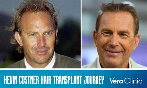 Kevin Costner Hair Transplant