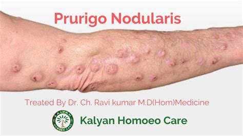 Best Homeopathy Treatment & Medicine For Prurigo Nodularis |Dr ...