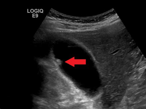 Gallbladder Polyps Ultrasound