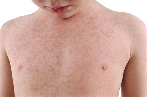 Rubella (German Measles): Symptoms, treatment, during pregnancy