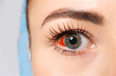 Are Broken Blood Vessels in Your Eye Dangerous? | Mississauga