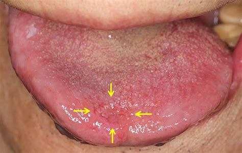 Early Squamous Cell Carcinoma Tongue