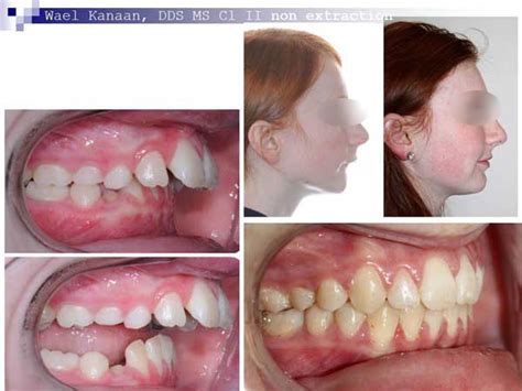 Overbite Correction in Houston and Sugarland TX - iSmile