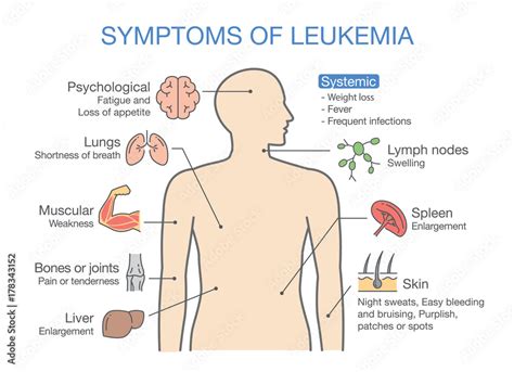 Common symptoms and signs of Leukemia. Medical illustration ideal for ...