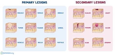 Macule Vs Papule