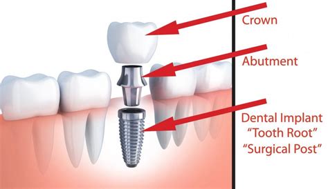 N Frisco TX, Frisco Oral And Dental Implant Surgery