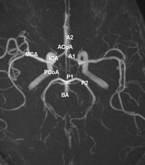 Circle Of Willis Mri