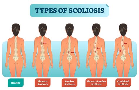 Scoliosis Treatment in Singapore | Live Well Chiropractic Singapore