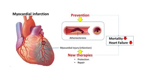 Myocardial Infarction | Icahn School of Medicine