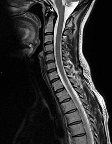 Mri Cervical Spine Neck Pain