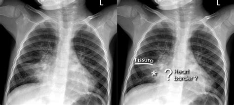 Rare Bulging Fissure Sign In Chest X-Ray (CXR) Of A Three, 47% OFF