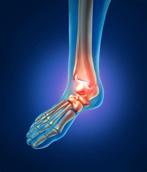 GOUT — Park Avenue Podiatry Associates