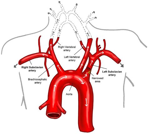 Subclavian Vein Heart