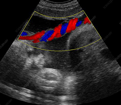 Umbilical cord blood flow, ultrasound - Stock Image P680/0755 - Science ...