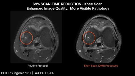 Precision in Knee MRI: Improved Pathology Visualization