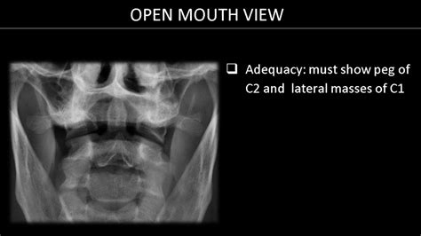 C spine radiology