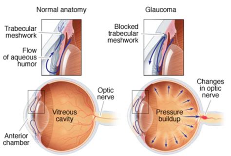 Cataract Vs Glaucoma: 13 Must Know Differences and Facts - Public ...