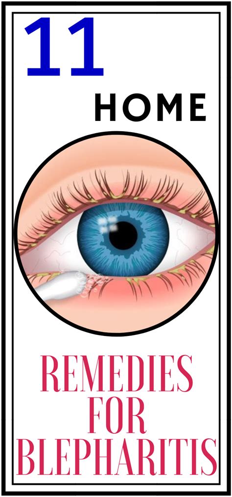 Run Healthy Lifestyle: 11 Home Remedies for Blepharitis