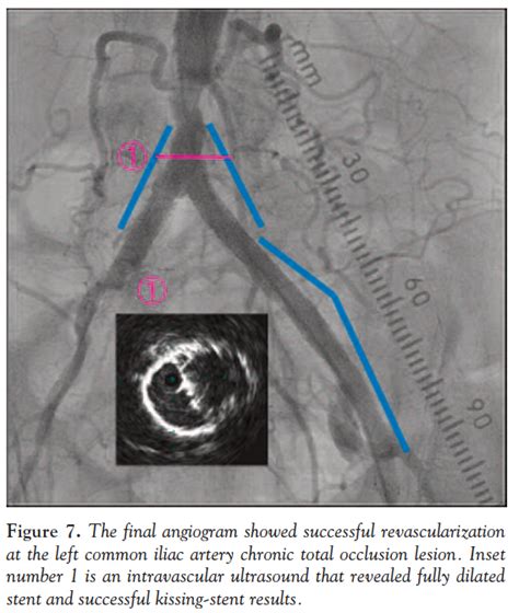 Kissing Iliac Artery Stent Technique for Salvage of a Total Occlusion ...