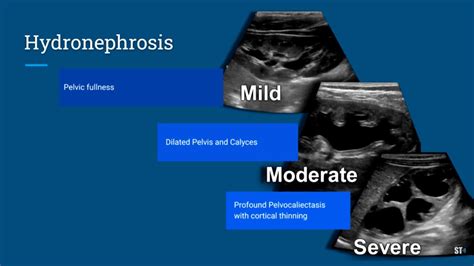 Hydronephrosis Grading Ultrasound