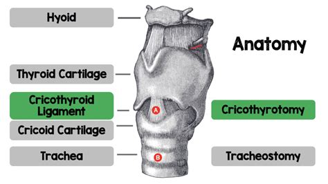 Bougie-Assisted Cricothyrotomy Anatomy - REBEL EM - Emergency Medicine Blog