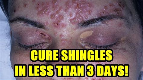 Shingles Treatment (2018) - Cure Shingles on Face and Shingles in The ...