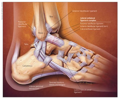 Lateral Ankle Sprain - Morphopedics