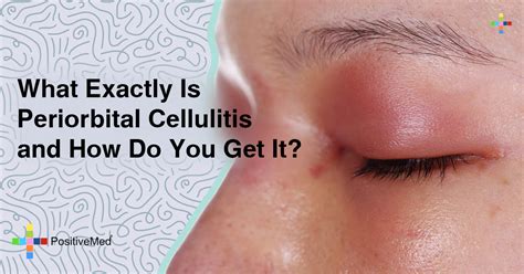 What Exactly Is Periorbital Cellulitis—and How Do You Get It?