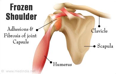 Frozen Shoulder | Adhesive Capsulitis - Causes, Symptoms, Diagnosis ...