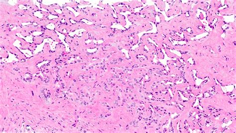 Pathology Outlines - Intrahepatic cholangiocarcinoma (small and large ...