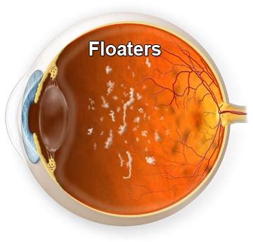 What are Floaters | Treatment of Floaters