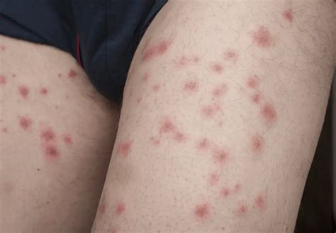 Eczema vs. Bed Bug Bites: How to Tell the Difference? (W/Pics)