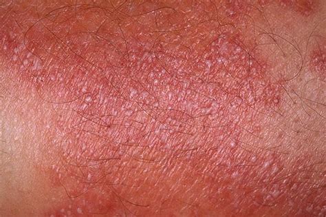 Pustular psoriasis symptoms pictures | Symptoms and pictures