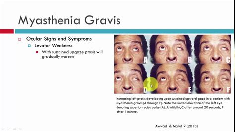 Myasthenia Gravis Symptoms