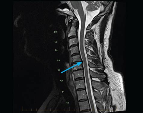 Adult MRI Series - MRI of Cervical spine: Radiculopathy