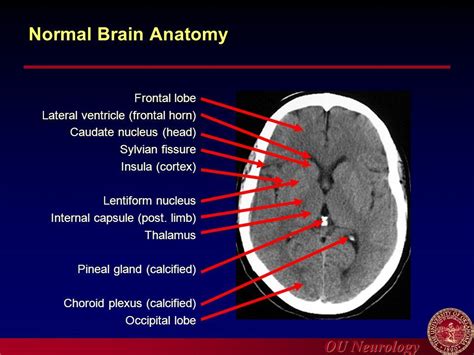 Axial View Of A Head Computed Tomography (CT) Scan Of Pineal Gland ...