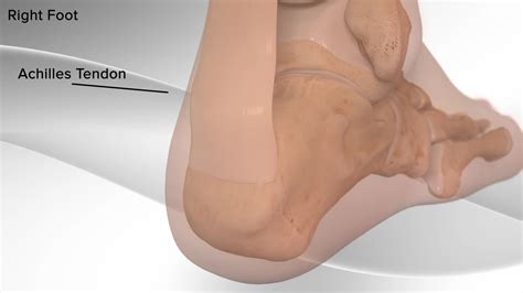 Arthrex - Achilles Tendon Repair with SpeedBridge™ System