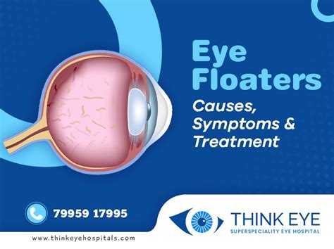 Eye Floaters Treatment in Hyderabad | Think Eye Hospitals