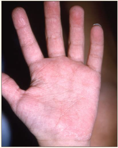 Boy With Rash on Hands and Feet | Consultant360