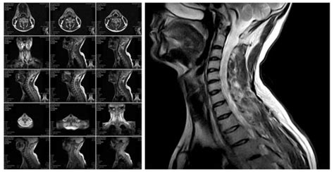 Mri Cervical Spine Nerve Damage