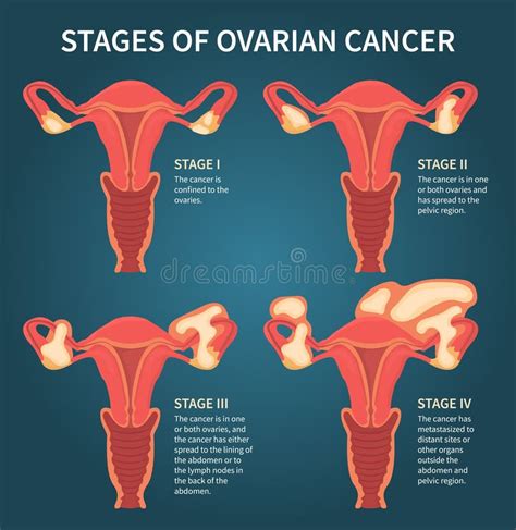 Stages of Womans Ovarian Cancer Dark Blue Scheme Stock Vector ...