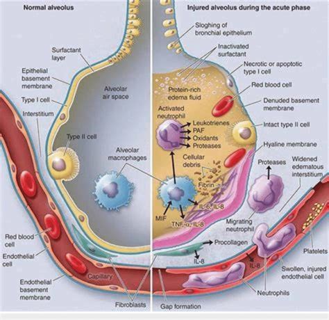 Mechanism of acute respiratory distress syndrome (ARDS) in the alveoli ...