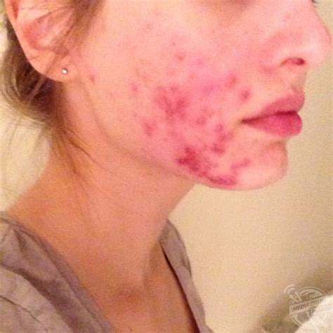 This Girl Developed Severe Cystic Acne That Left Her Face Permanently ...