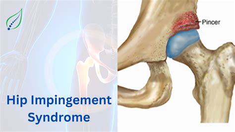 Non-Surgical Treatment for Hip Impingement Syndrome | Best Back Pain ...