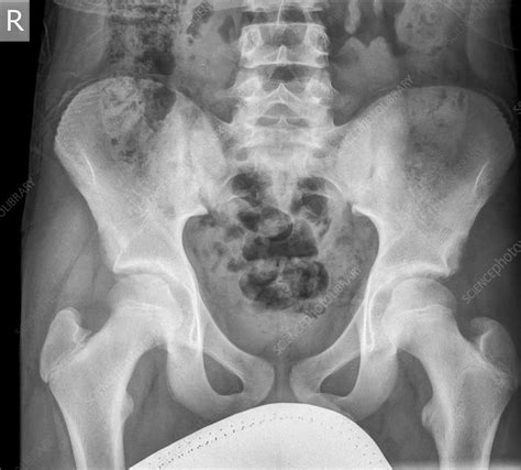 Adult Male Pelvis X Ray