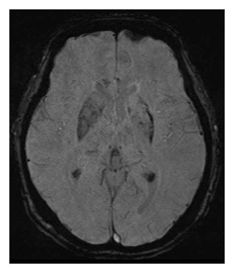 MRI changes in the left corpus striatum related to hemichorea ...