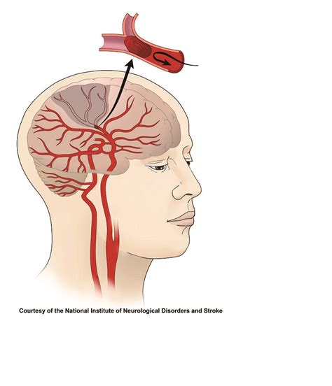 Ischemic Stroke | Illustration of an ischemic stroke, which … | Flickr