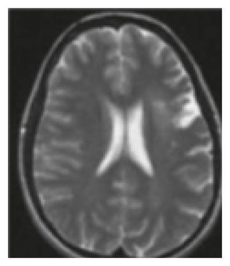 MRI image of cerebral infarction. | Download Scientific Diagram