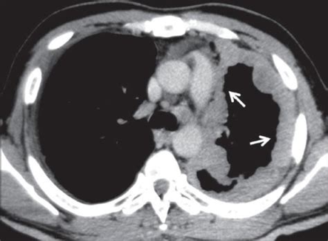 Malignant mesothelioma: Axial contrast-enhanced CT scan | Open-i